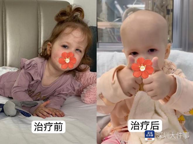 基因治療“逆天改命”！瑞典罕見遺傳病患兒萬里赴粵重獲新生(圖2)